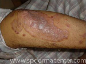 Psoriasis-Treated